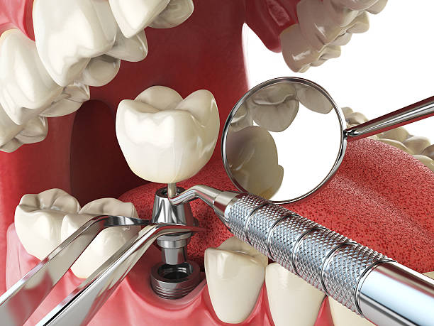 Best Emergency Root Canal Treatment in Ptland, OR